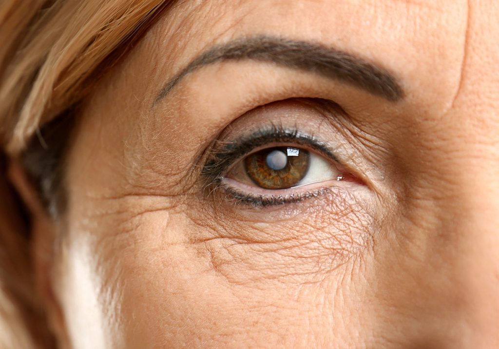 Cataract Surgery in Orange County for Better Screen Time