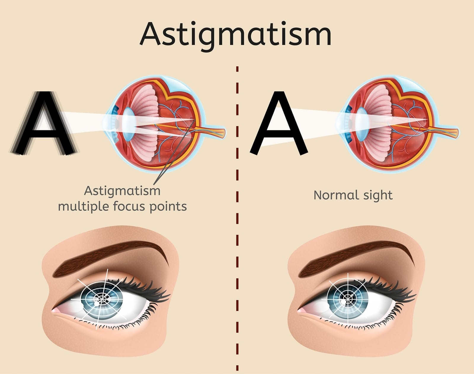 Lasik Eye Surgery Cost For Astigmatism Excel Eye